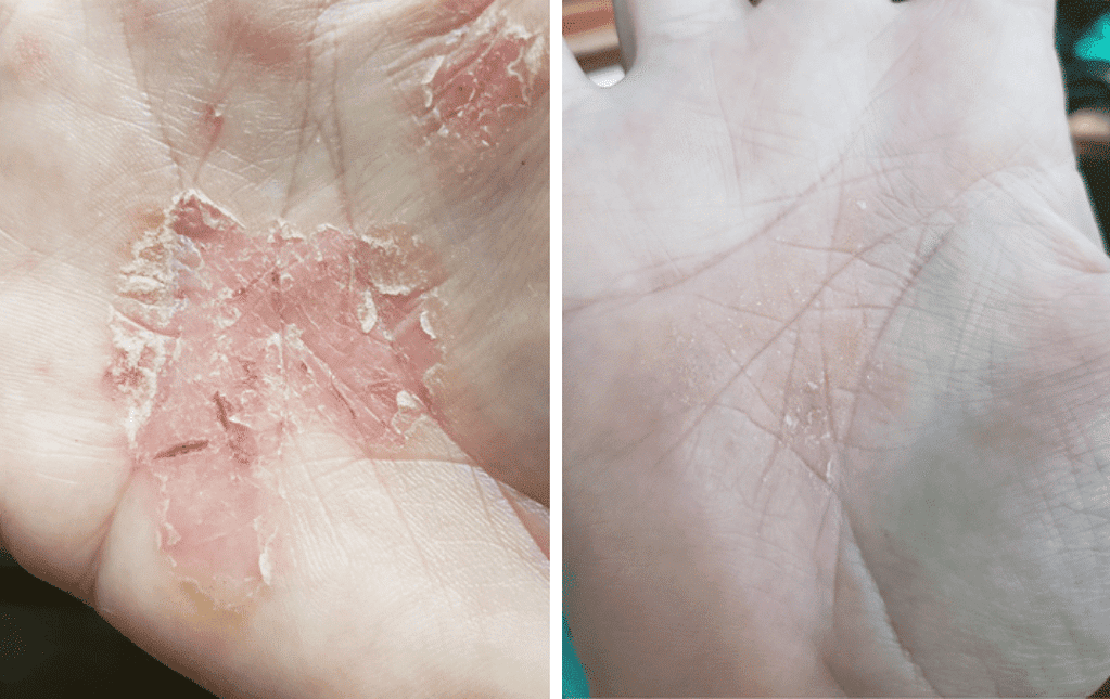 a close up of a hand with a rash