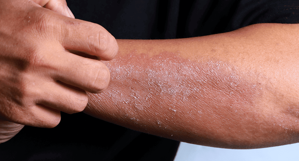 red light therapy for eczema