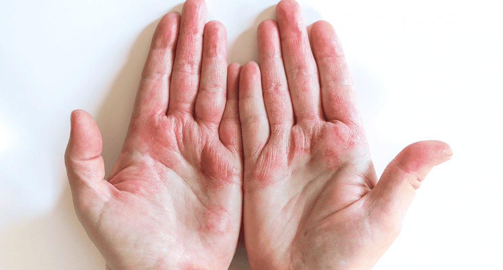 red light therapy for eczema