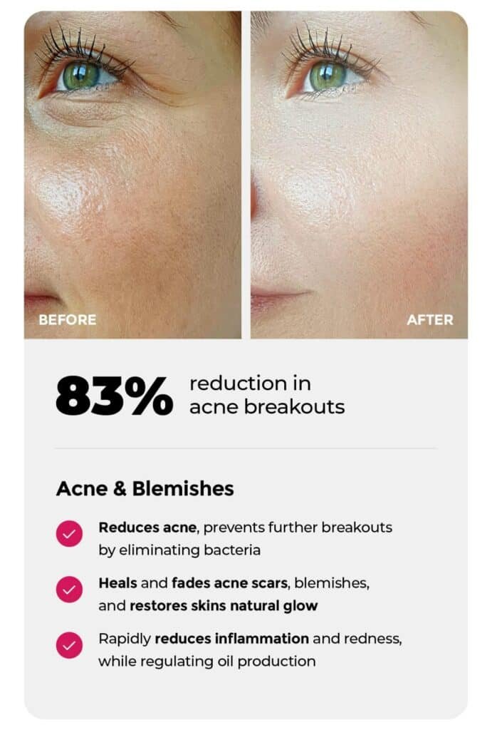 red light therapy for acne